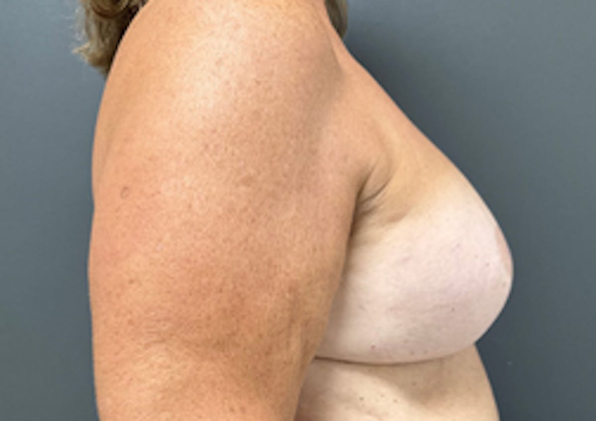 Breast Reconstruction Before & After Gallery - Patient 350092 - Image 3