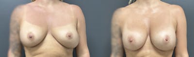 Breast Implant Exchange Before & After Gallery - Patient 238784 - Image 1