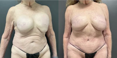 Abdominoplasty (Tummy Tuck) Before & After Gallery - Patient 248541 - Image 1