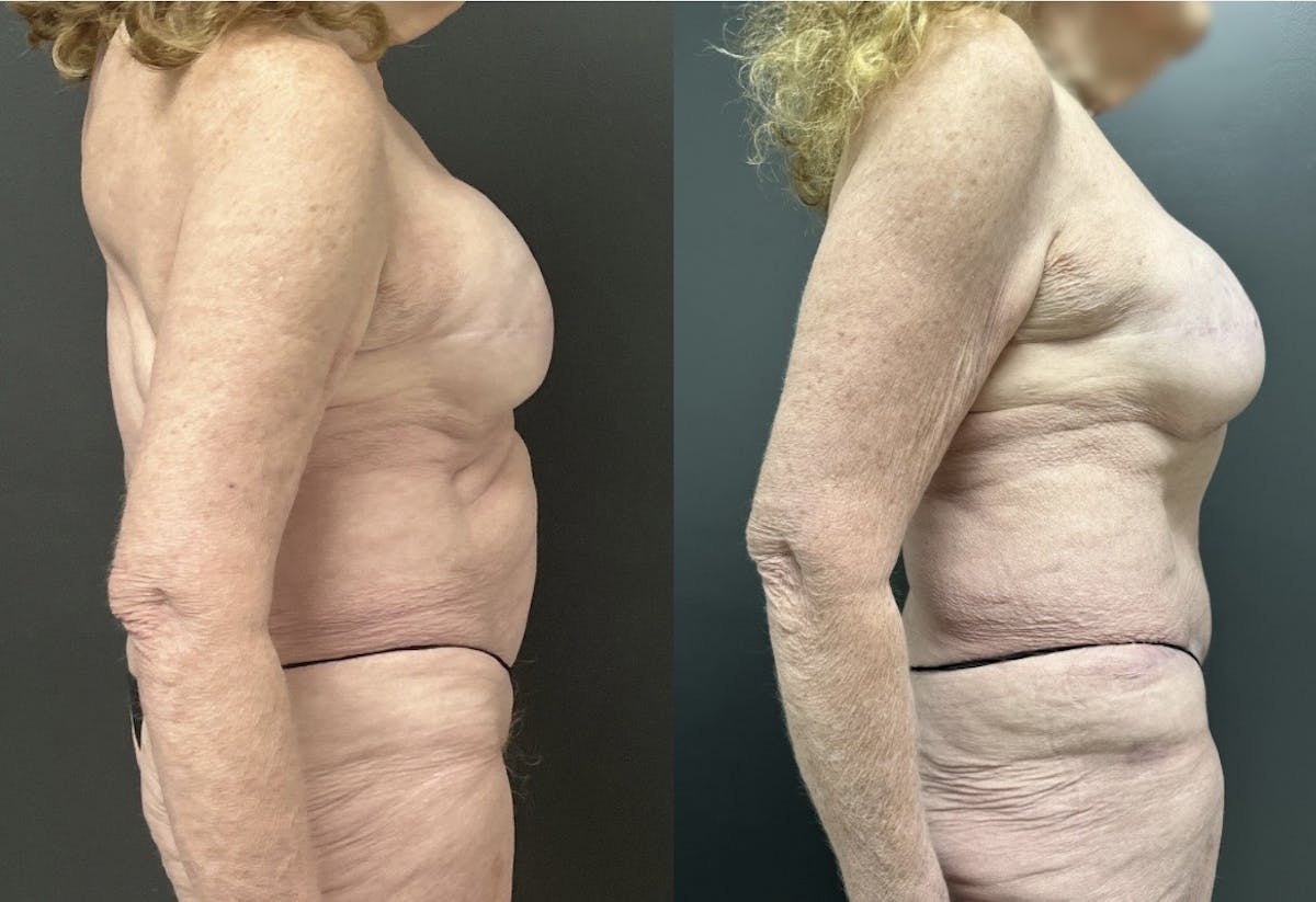 Abdominoplasty (Tummy Tuck) Before & After Gallery - Patient 248541 - Image 2