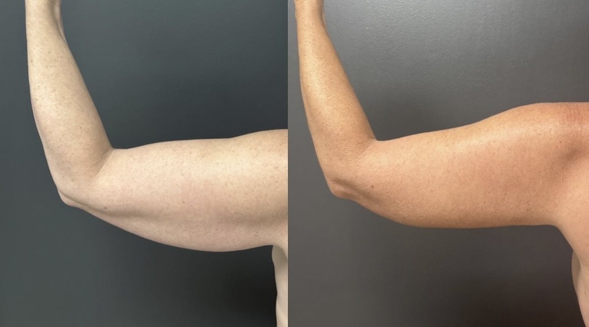 Brachioplasty (Arm Lift) Before & After Gallery - Patient 342341 - Image 3
