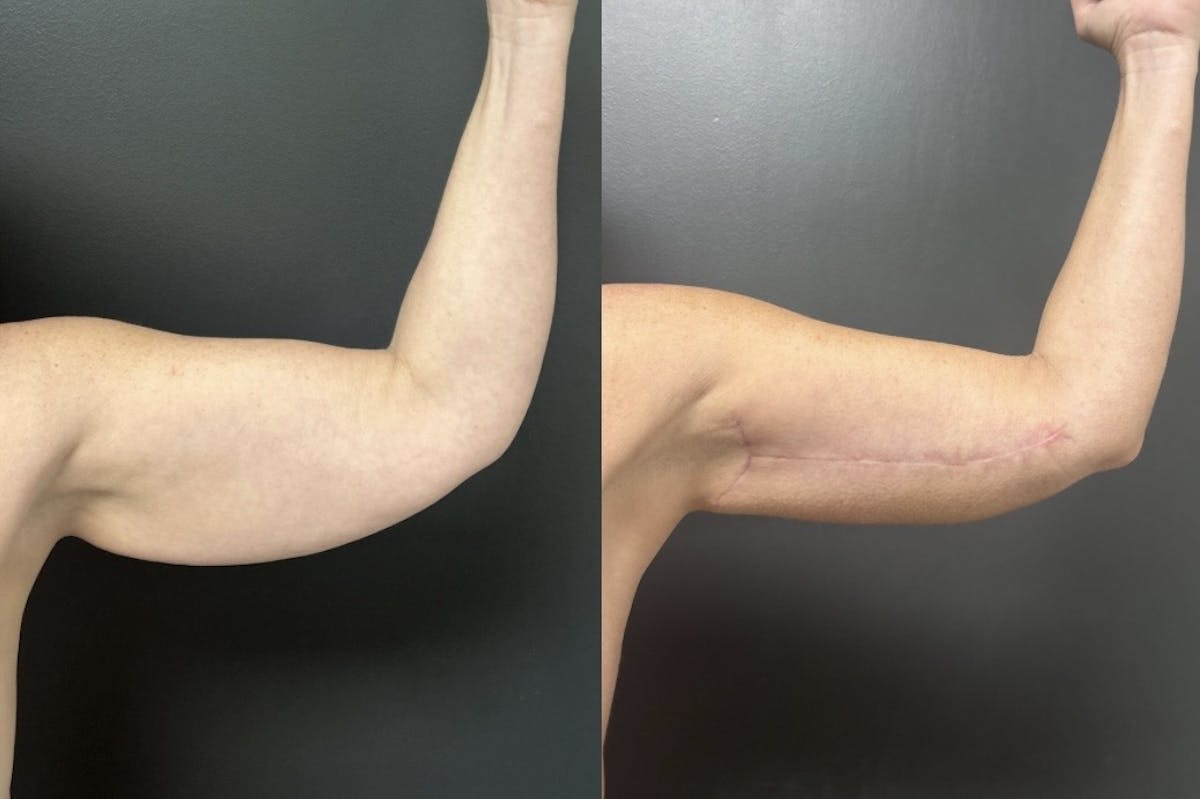 Brachioplasty (Arm Lift) Before & After Gallery - Patient 342341 - Image 2