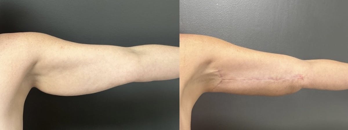 Brachioplasty (Arm Lift) Before & After Gallery - Patient 342341 - Image 1