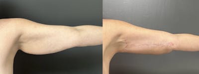 Brachioplasty (Arm Lift) Before & After Gallery - Patient 342341 - Image 1
