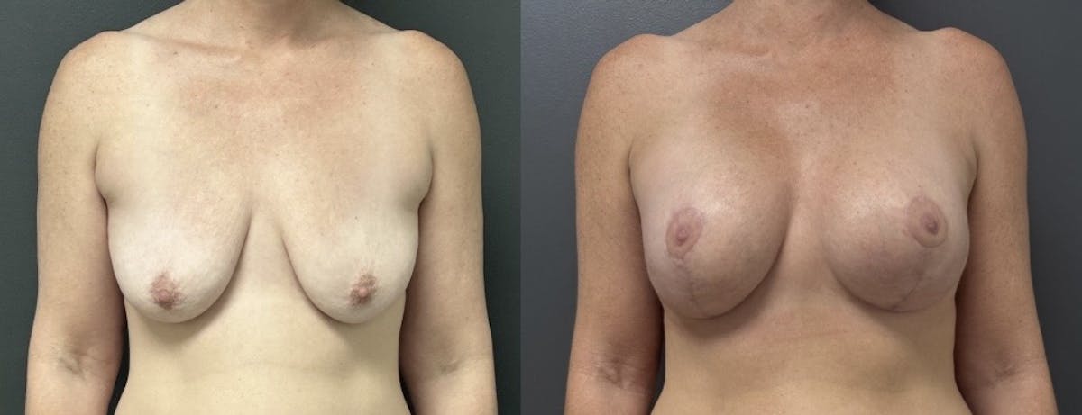 Breast Augmentation with Lift Before & After Gallery - Patient 416748 - Image 1