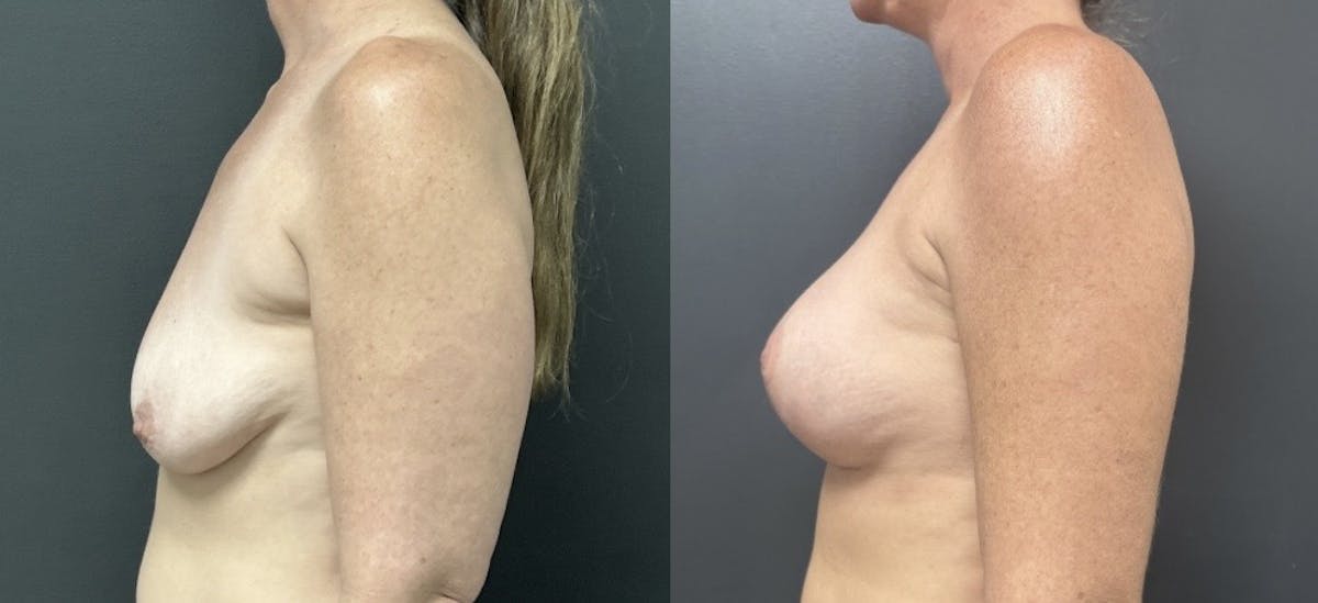 Breast Augmentation with Lift Before & After Gallery - Patient 416748 - Image 3