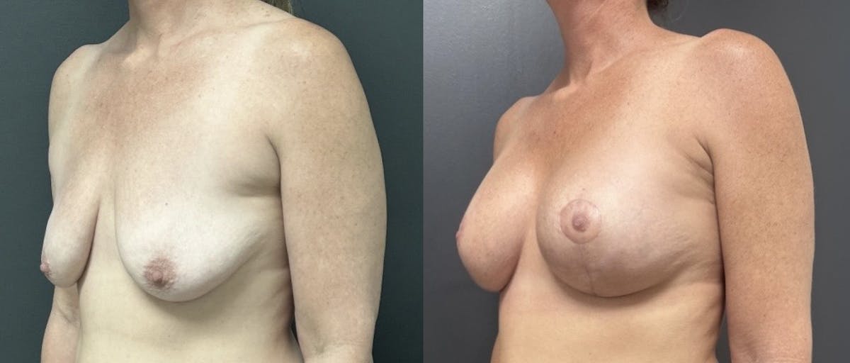 Breast Augmentation with Lift Before & After Gallery - Patient 416748 - Image 2