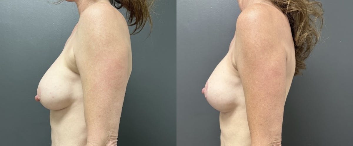 Breast Augmentation with Lift Before & After Gallery - Patient 208710 - Image 3