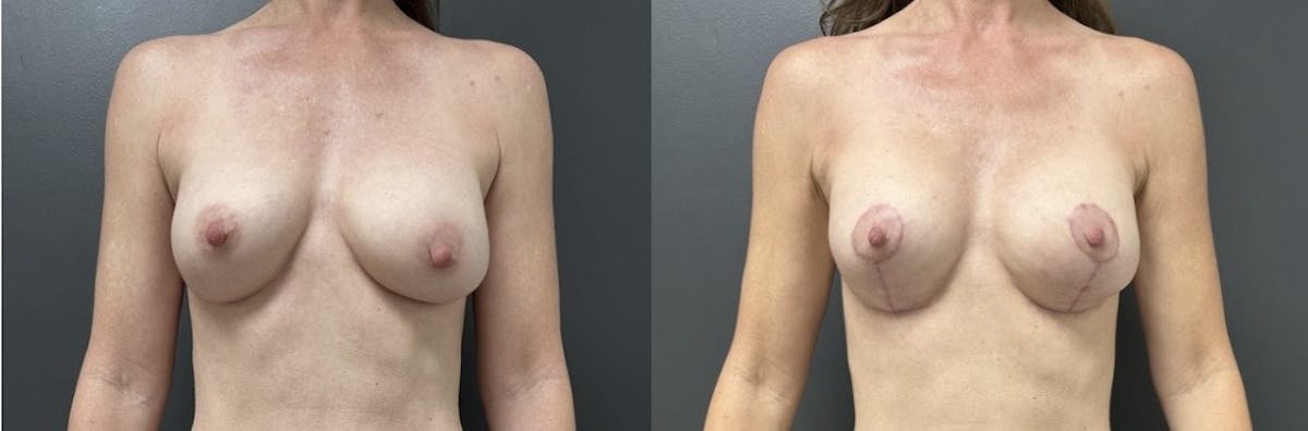 Breast Augmentation with Lift Before & After Gallery - Patient 208710 - Image 1