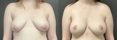 Breast Augmentation with Lift Before & After Gallery - Patient 345774 - Image 1