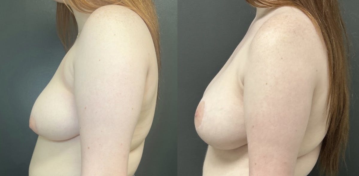 Breast Augmentation with Lift Before & After Gallery - Patient 345774 - Image 3