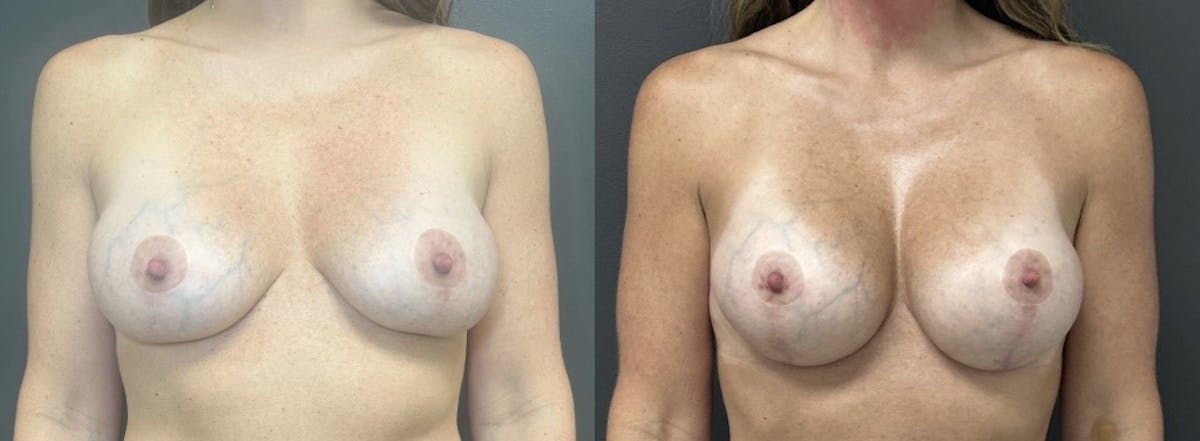 Breast Augmentation with Lift Before & After Gallery - Patient 130604 - Image 1