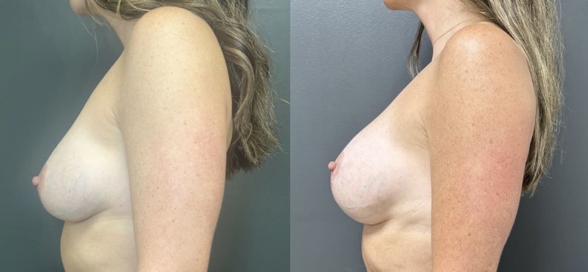 Breast Augmentation with Lift Before & After Gallery - Patient 130604 - Image 3