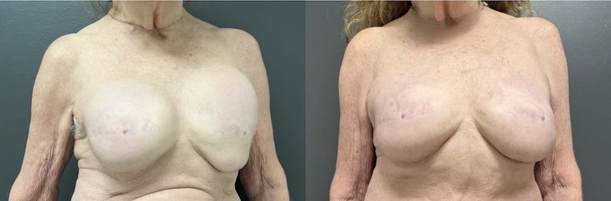Breast Reconstruction Before & After Gallery - Patient 168638 - Image 1