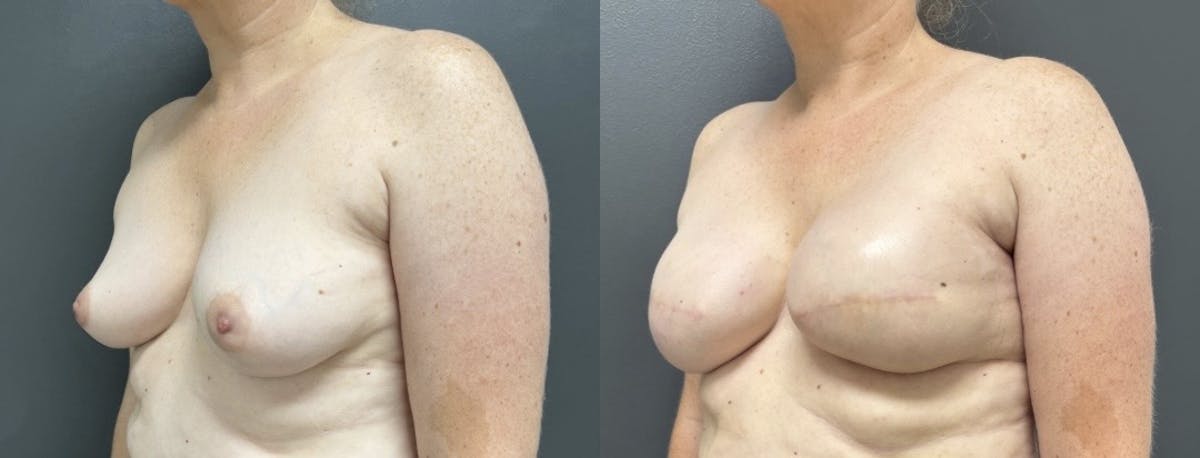 Breast Reconstruction Before & After Gallery - Patient 190934 - Image 2