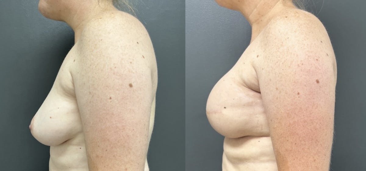 Breast Reconstruction Before & After Gallery - Patient 190934 - Image 3