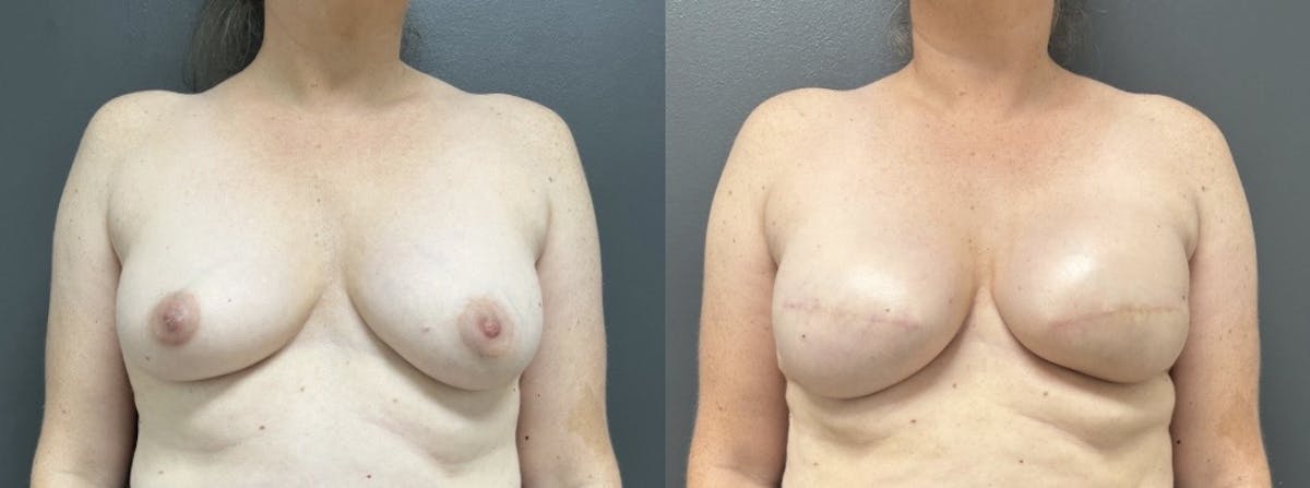 Breast Reconstruction Before & After Gallery - Patient 190934 - Image 1