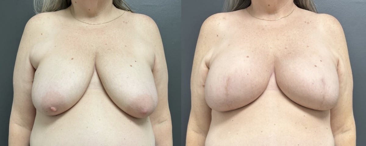 Breast Reconstruction Before & After Gallery - Patient 165718 - Image 1