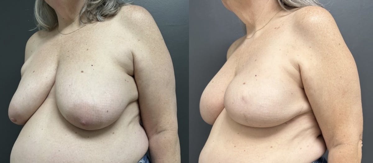 Breast Reconstruction Before & After Gallery - Patient 165718 - Image 2