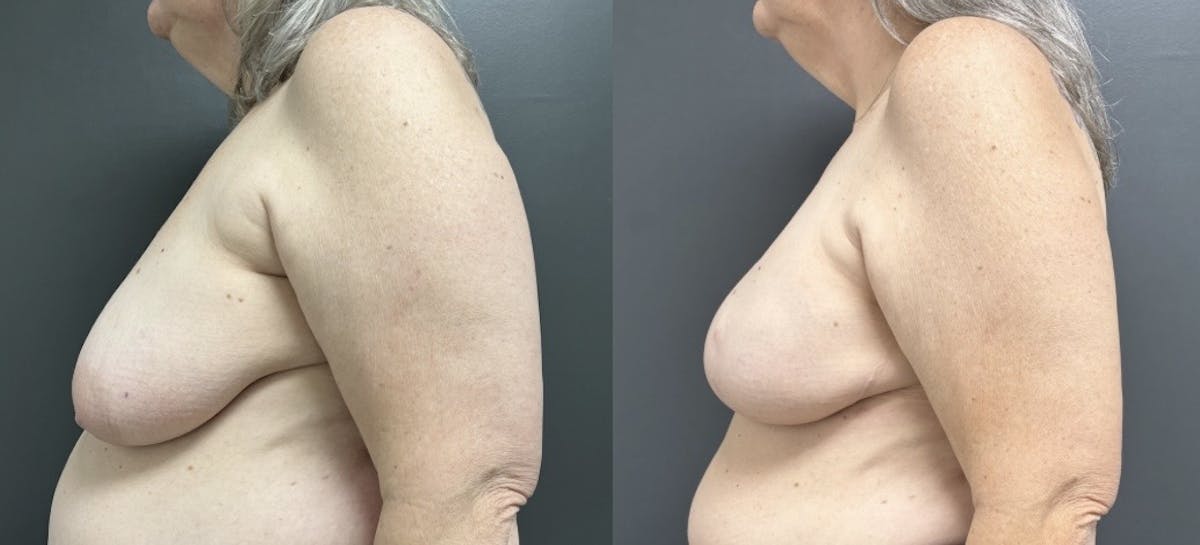 Breast Reconstruction Before & After Gallery - Patient 165718 - Image 3