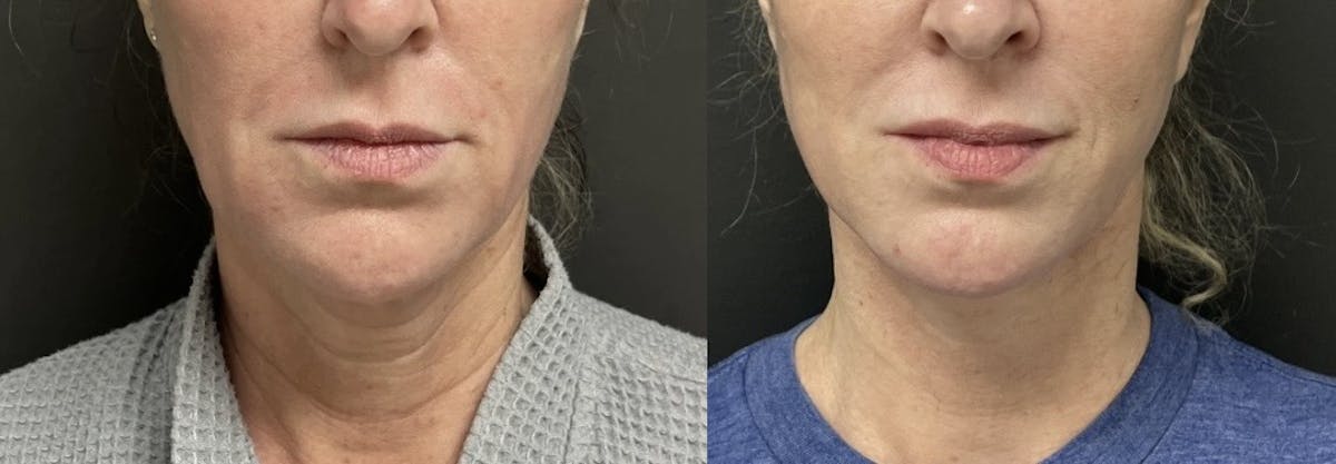 Facelift Before & After Gallery - Patient 236765 - Image 1