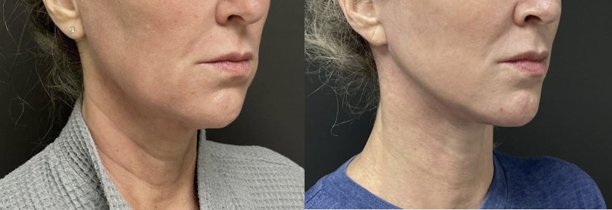 Facelift Before & After Gallery - Patient 236765 - Image 2