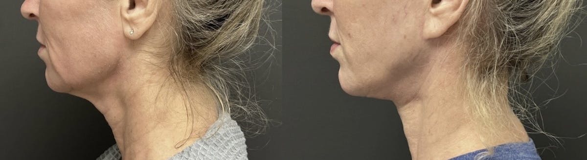 Facelift Before & After Gallery - Patient 236765 - Image 3