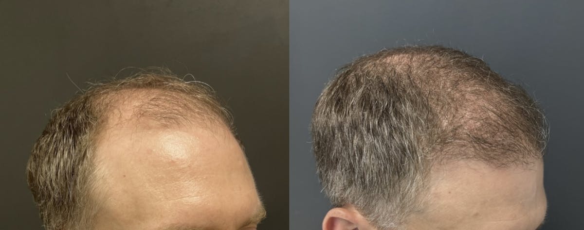 Hair Transplant Before & After Gallery - Patient 290695 - Image 3