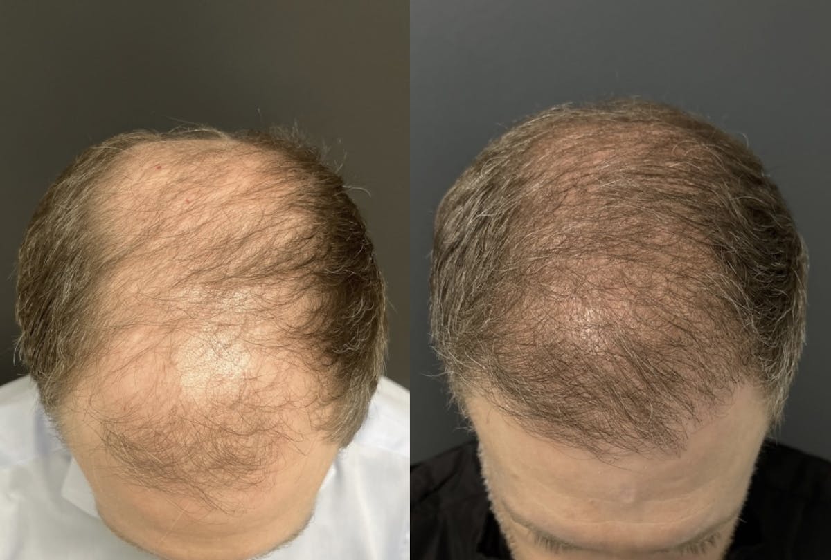 Hair Transplant Before & After Gallery - Patient 290695 - Image 2