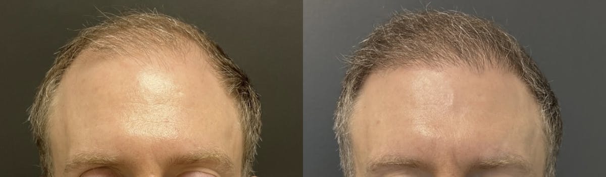 Hair Transplant Before & After Gallery - Patient 290695 - Image 1
