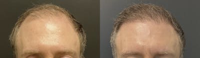 Hair Transplant Before & After Gallery - Patient 290695 - Image 1