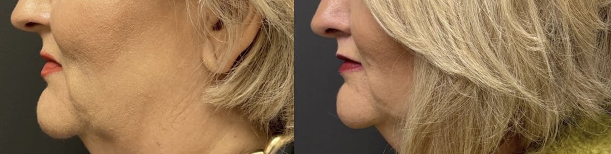 Lip Lift Before & After Gallery - Patient 357790 - Image 2