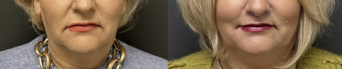 Lip Lift Before & After Gallery - Patient 357790 - Image 1
