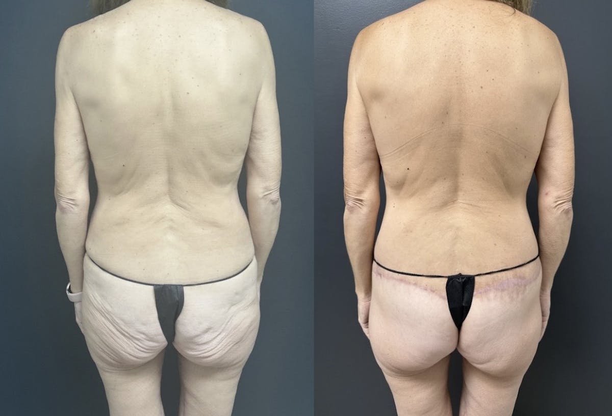 Lower Body Lift Before & After Gallery - Patient 248302 - Image 1