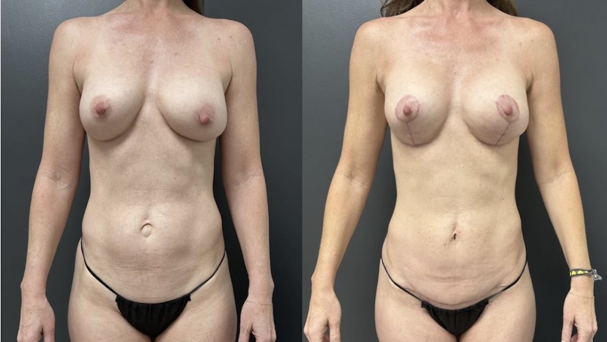 Mini Abdominoplasty Before & After Gallery - Patient 211013 - Image 1