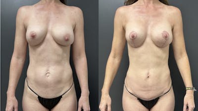 Mini Abdominoplasty Before & After Gallery - Patient 211013 - Image 1