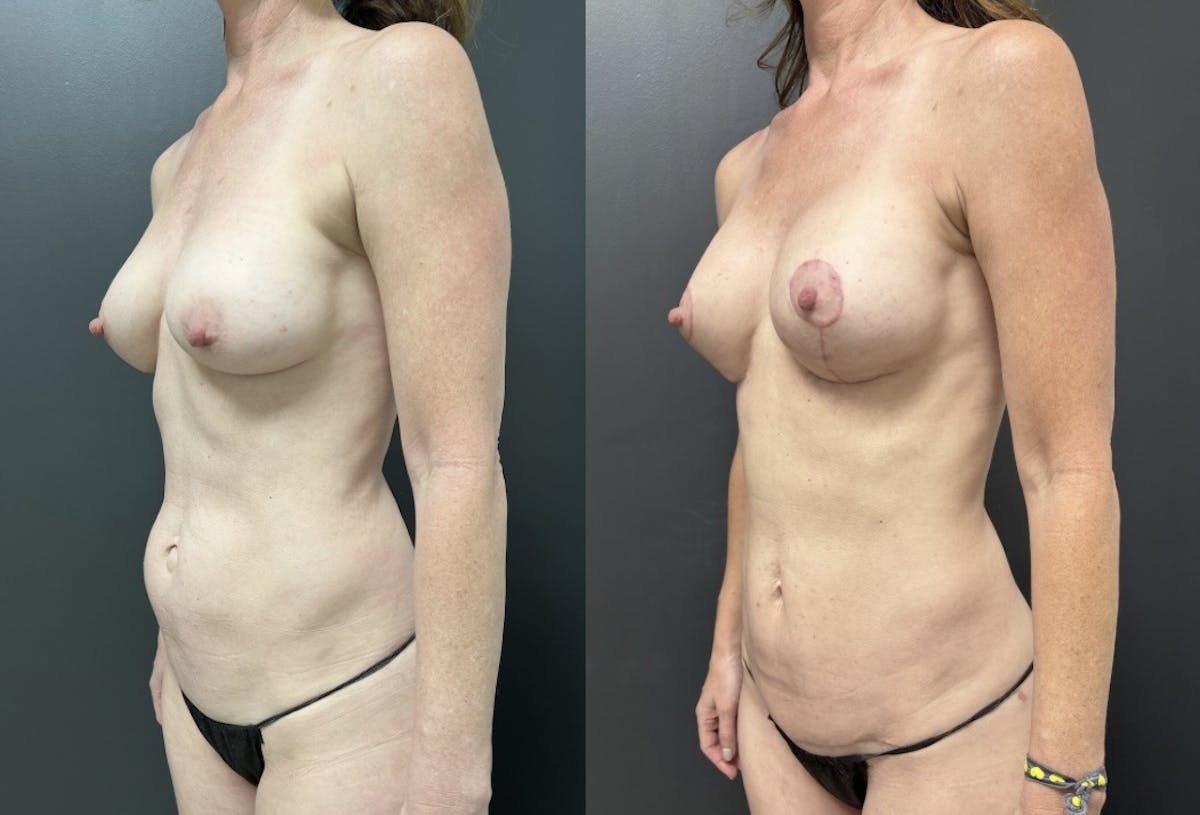 Mini Abdominoplasty Before & After Gallery - Patient 211013 - Image 2