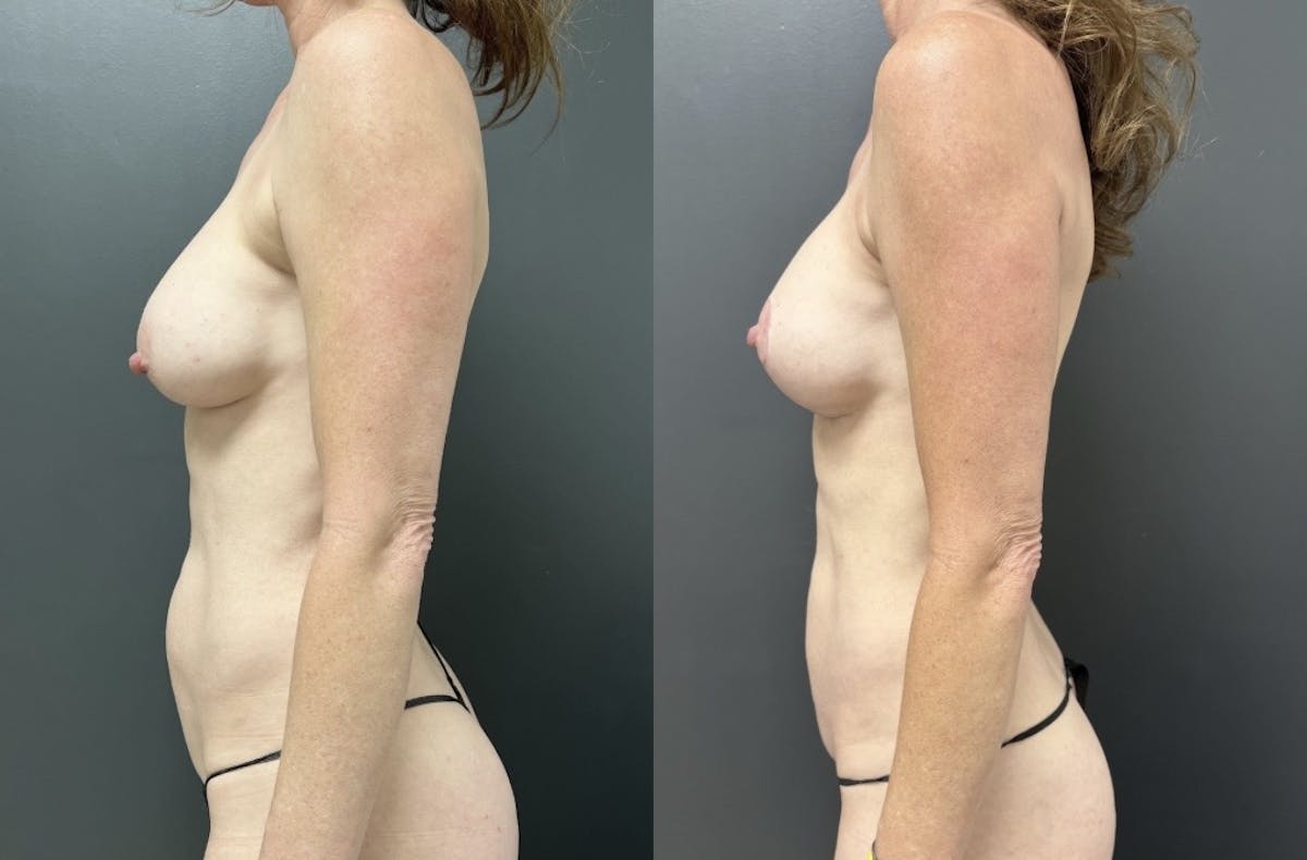 Mini Abdominoplasty Before & After Gallery - Patient 211013 - Image 3
