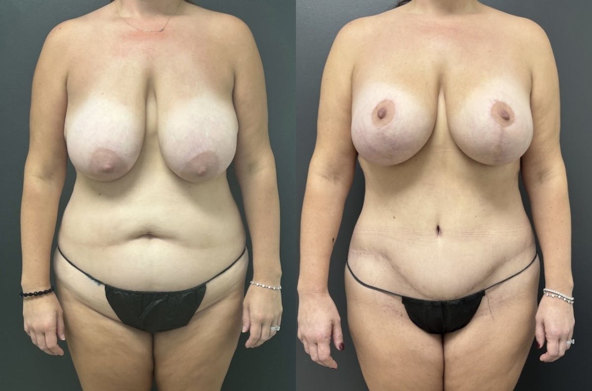 Abdominoplasty (Tummy Tuck) Before & After Gallery - Patient 749708 - Image 1