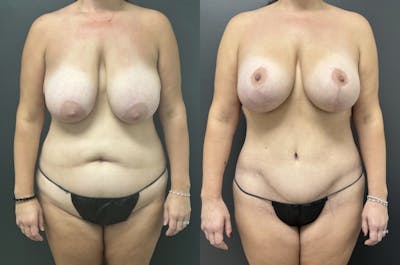 Abdominoplasty (Tummy Tuck) Before & After Gallery - Patient 749708 - Image 1