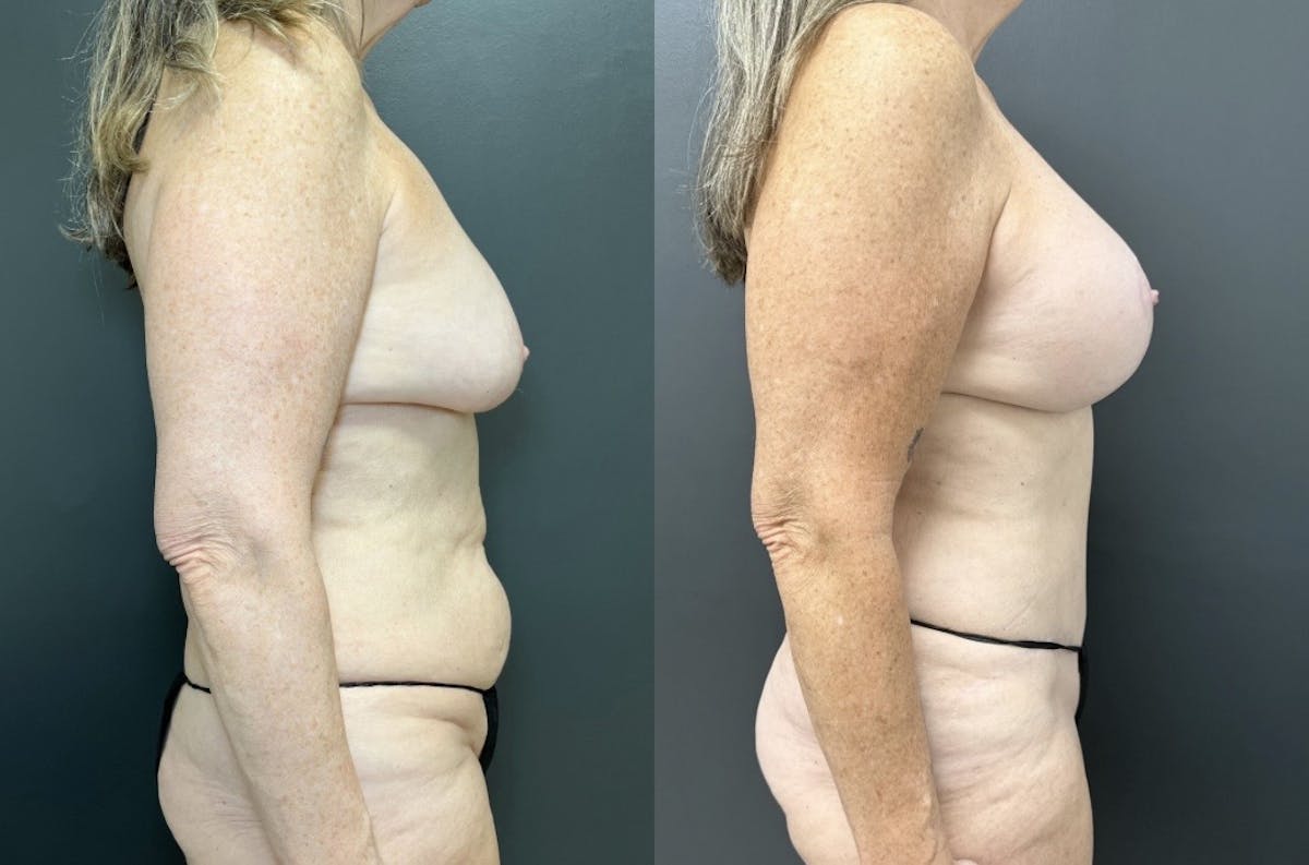 Abdominoplasty (Tummy Tuck) Before & After Gallery - Patient 106326 - Image 3
