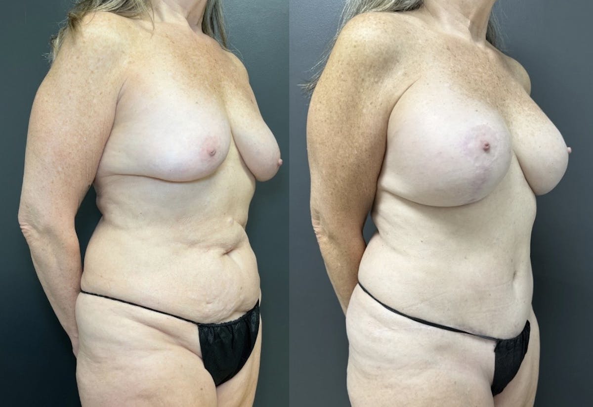 Abdominoplasty (Tummy Tuck) Before & After Gallery - Patient 106326 - Image 2