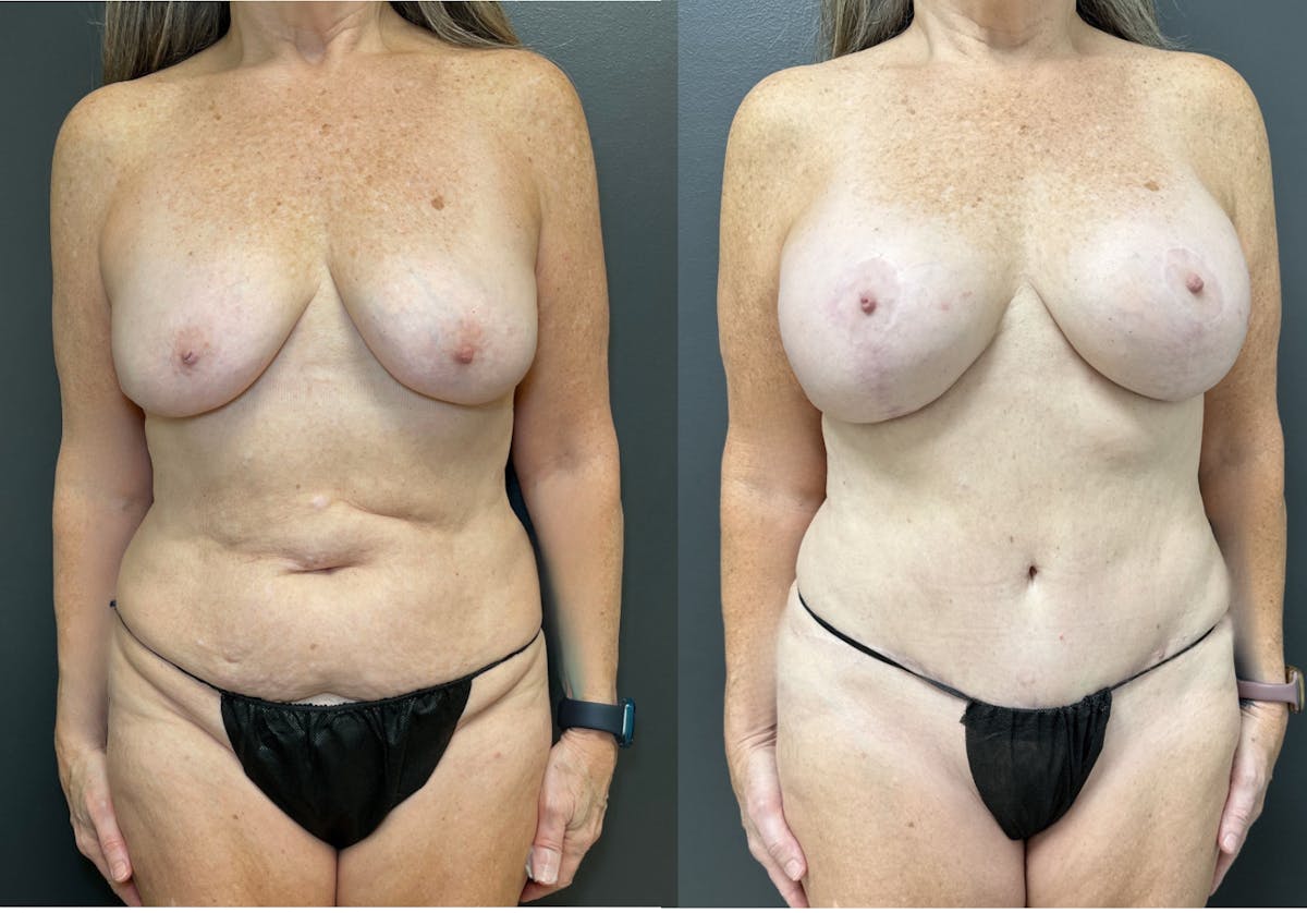 Abdominoplasty (Tummy Tuck) Before & After Gallery - Patient 106326 - Image 1