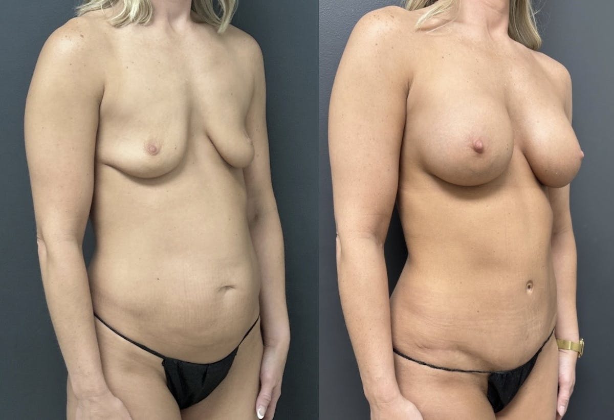 Abdominoplasty (Tummy Tuck) Before & After Gallery - Patient 849568 - Image 2