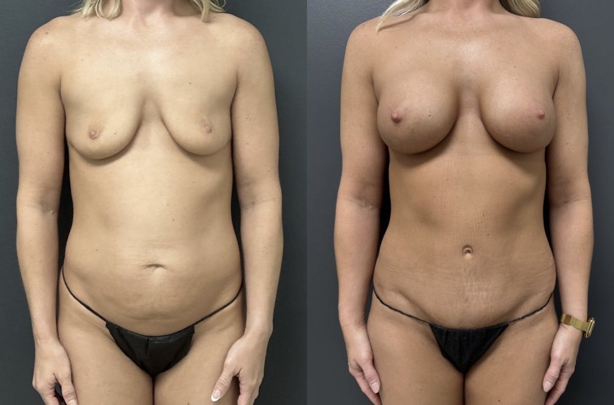 Abdominoplasty (Tummy Tuck) Before & After Gallery - Patient 849568 - Image 1