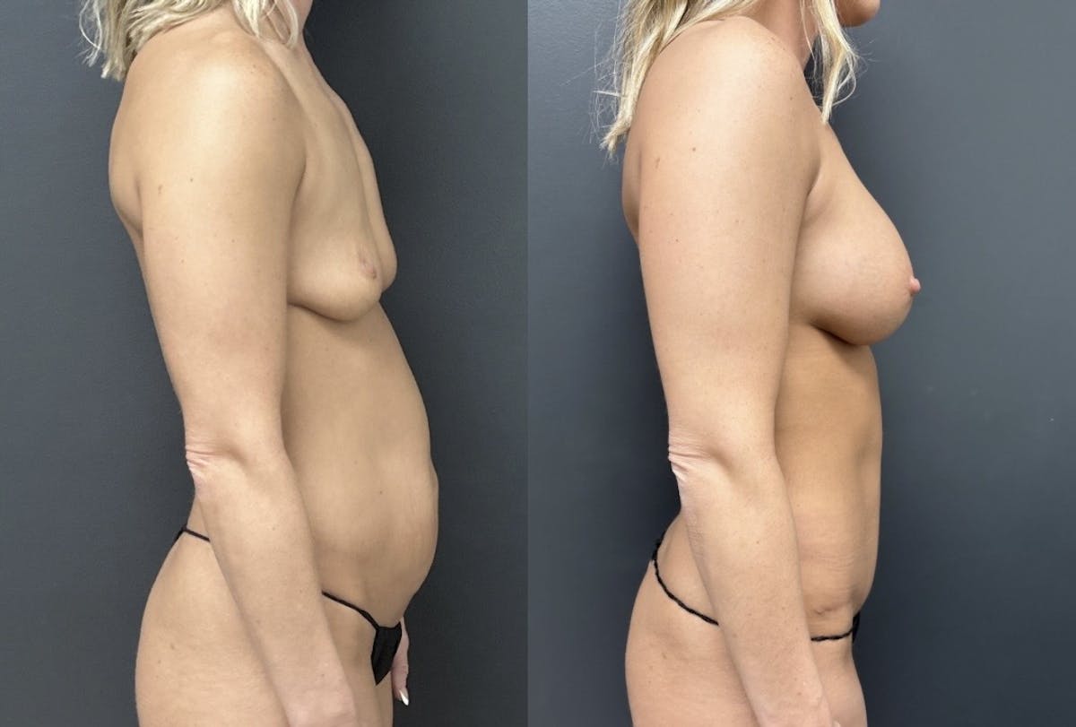 Abdominoplasty (Tummy Tuck) Before & After Gallery - Patient 849568 - Image 3