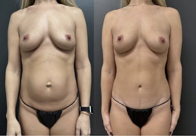 Abdominoplasty (Tummy Tuck) Before & After Gallery - Patient 377618 - Image 1