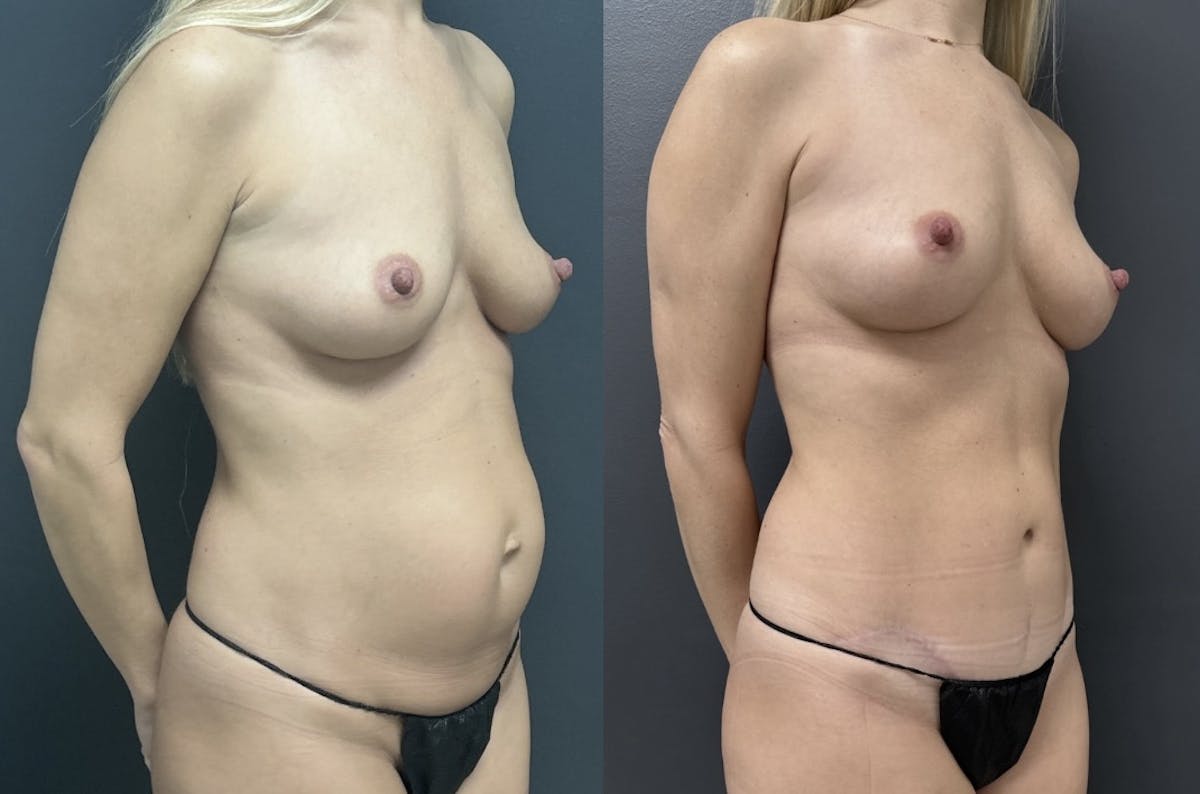 Abdominoplasty (Tummy Tuck) Before & After Gallery - Patient 377618 - Image 2
