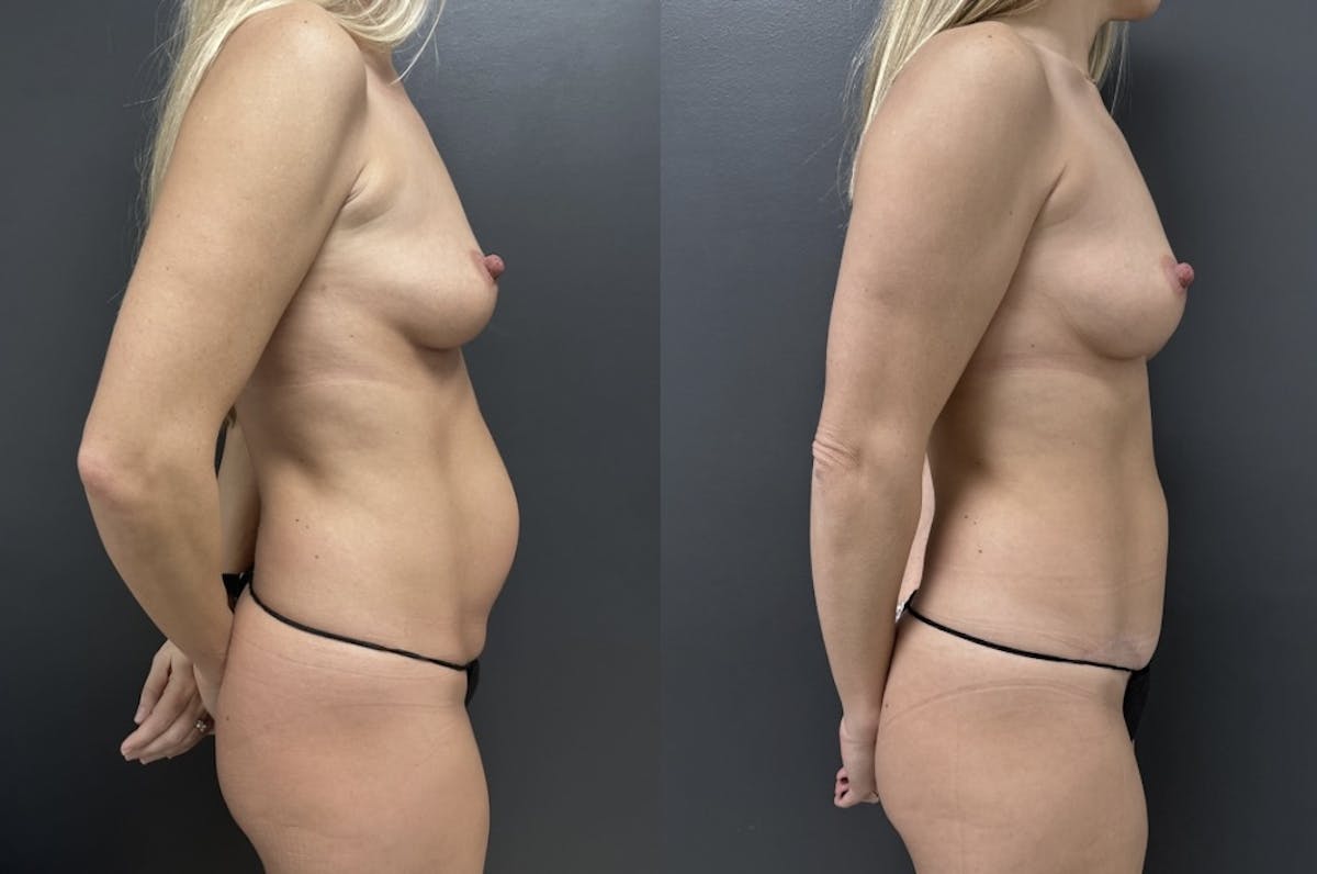 Abdominoplasty (Tummy Tuck) Before & After Gallery - Patient 377618 - Image 3