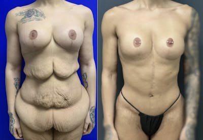 Fleur De Lis Abdominoplasty Before & After Gallery - Patient 134950 - Image 1